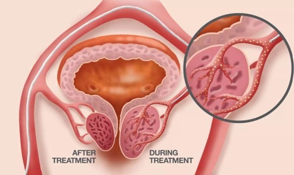 Interventional Radiologist at Manipal Hospital Treats Rare Giant Prostate Cases Without Surgery Using Advanced Minimally Invasive Technique